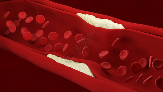 动脉粥样硬化红细胞动脉形成斑块动脉壁失去弹增厚和硬化血流量背景图片
