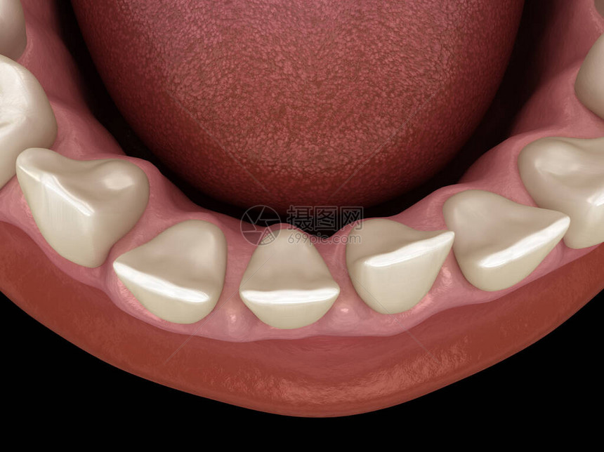 牙齿间距过大牙科3D插图概念图片