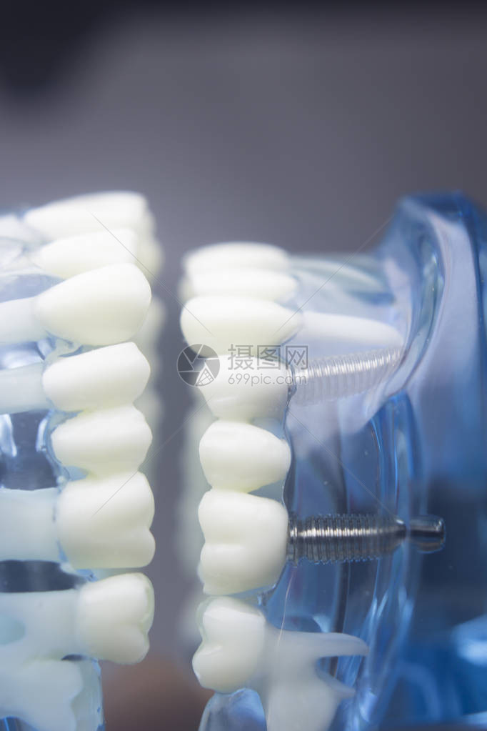 牙科学生习教学模型显示钛金属植入物螺丝牙根牙龈牙龈疾病图片
