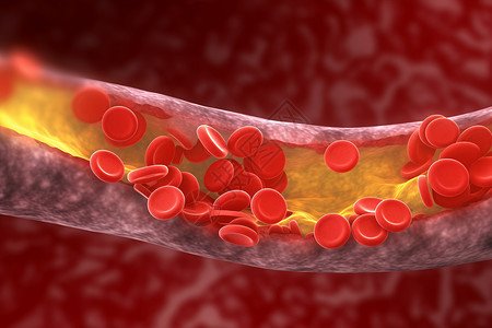 胆固醇堆积动脉中的胆固醇斑块医学概念3d效果图设计图片