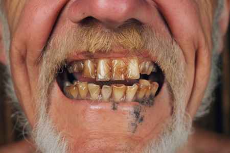 老人的牙齿被腐蚀高清图片