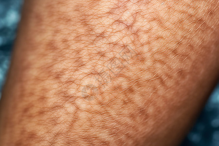 人腿上的干性皮肤特写高清图片