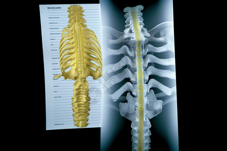 人体脊柱骨质疏松症背景