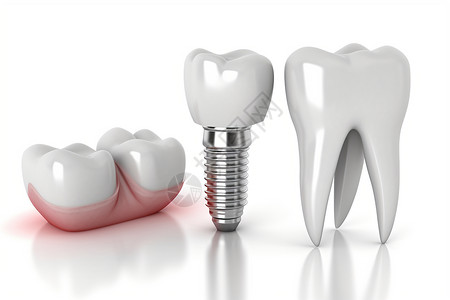 修复牙齿硅胶植入物高清图片