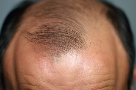 男性植发手术图片