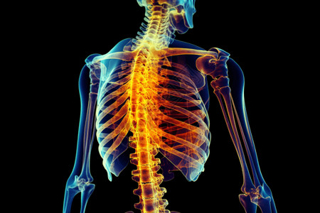 脊柱侧弯的彩色x射线扫描图高清图片