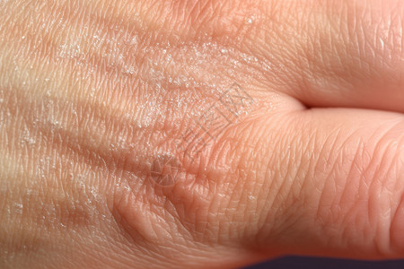 皮肤表皮有皮肤病的手背景