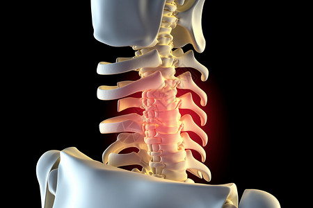 神经疼痛病变的脊柱插画