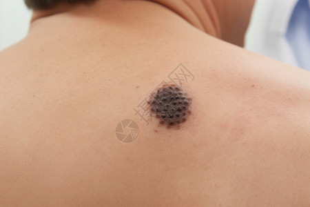 精原细胞瘤男子后背皮肤的黑色素瘤背景