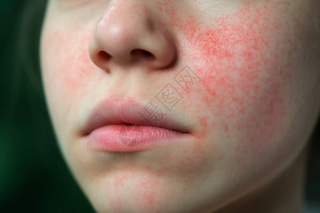脸上斑点女孩脸部的皮炎症背景