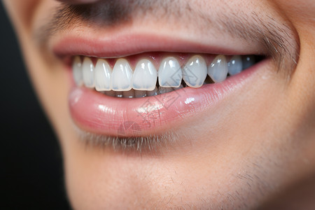安装透明牙套的牙齿高清图片